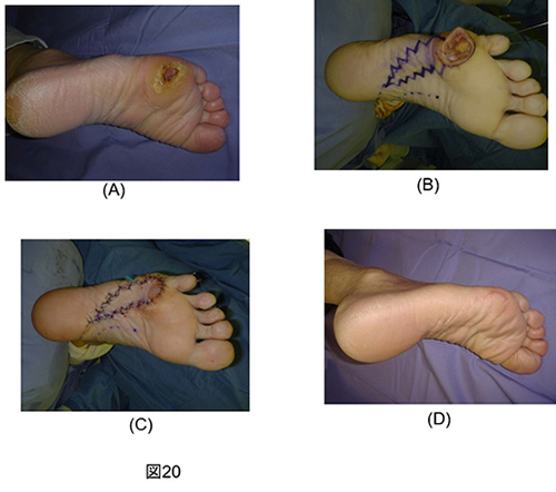 下肢難治性潰瘍_図20