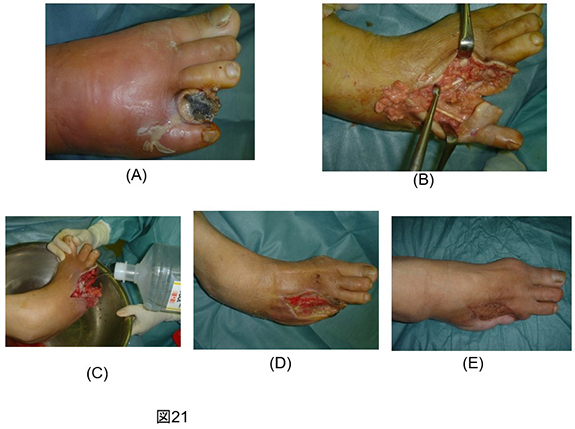 下肢難治性潰瘍_図21