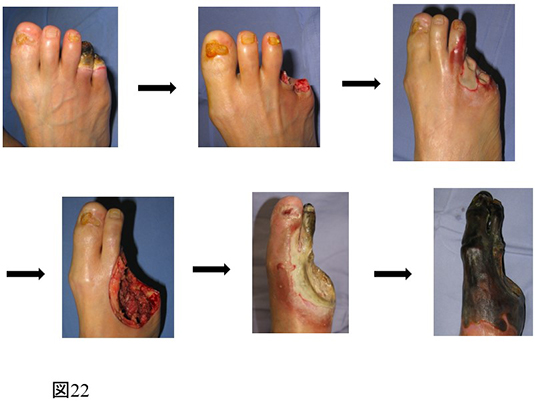 下肢難治性潰瘍_図22