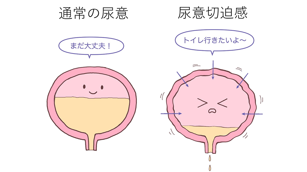 泌尿器科_過活動膀胱