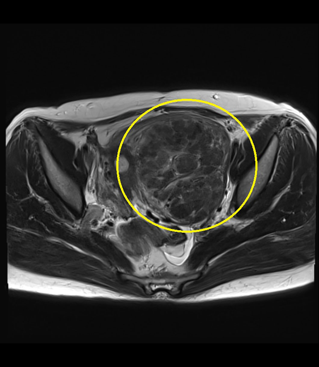 MRI 子宮筋腫 axi marked