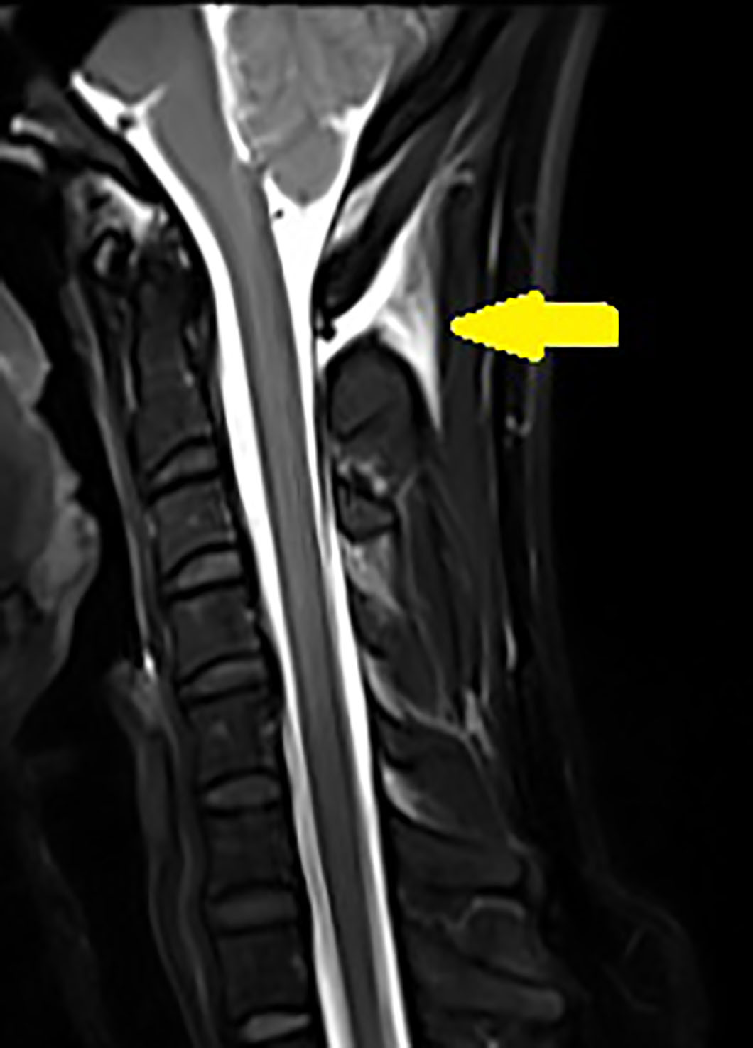 脳脊髄液減少症 MRI C1_2 sign