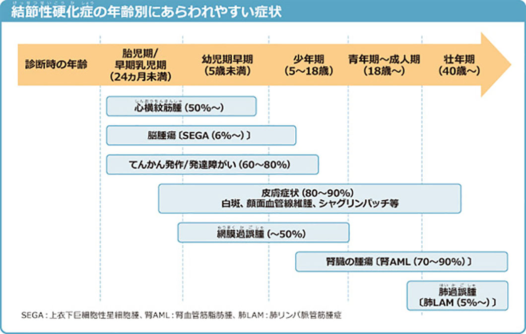 結節性硬化症