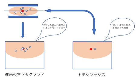 トモシンセシスとは_01