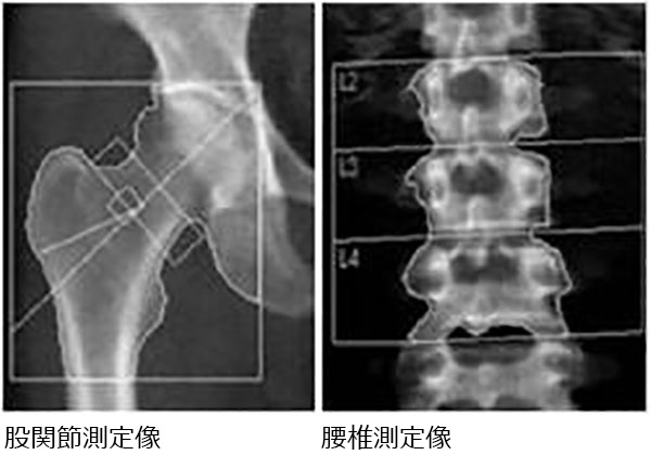 股関節測定像_腰椎測定像