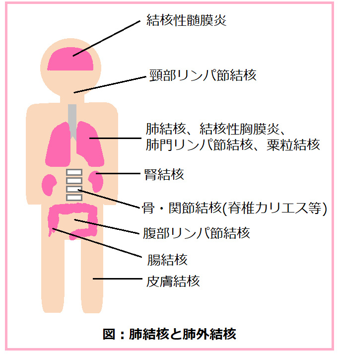 結核