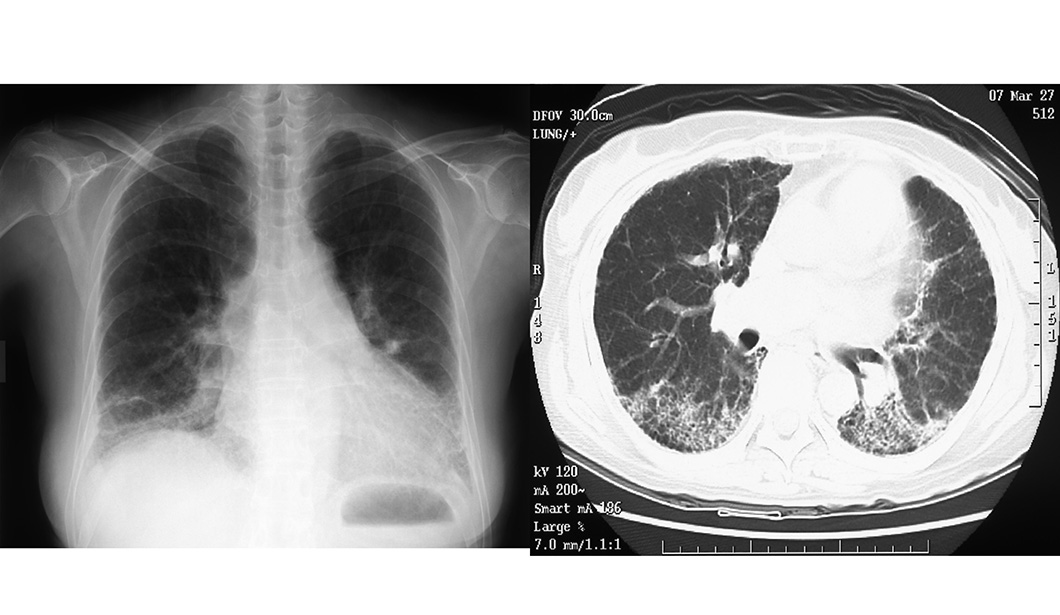 図8.間質性肺炎