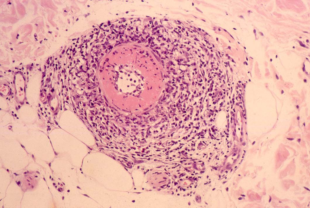 図19. 皮膚生検像、壊死性血管炎を示す