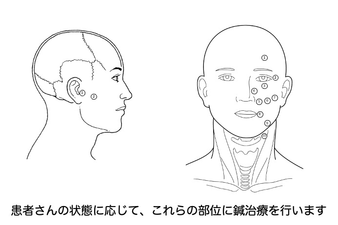 顔面神経麻痺鍼治療画像