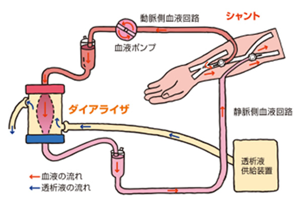 血液透析