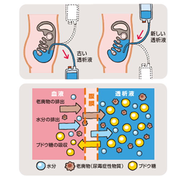 腹膜透析のしくみ