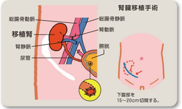 腎移植手術