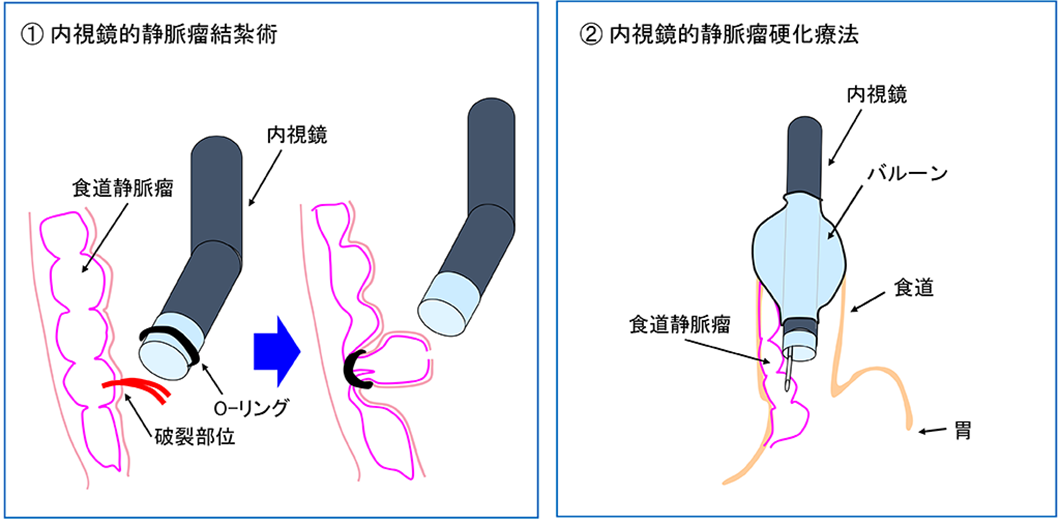 図10　食道静脈瘤に対する内視鏡的治療