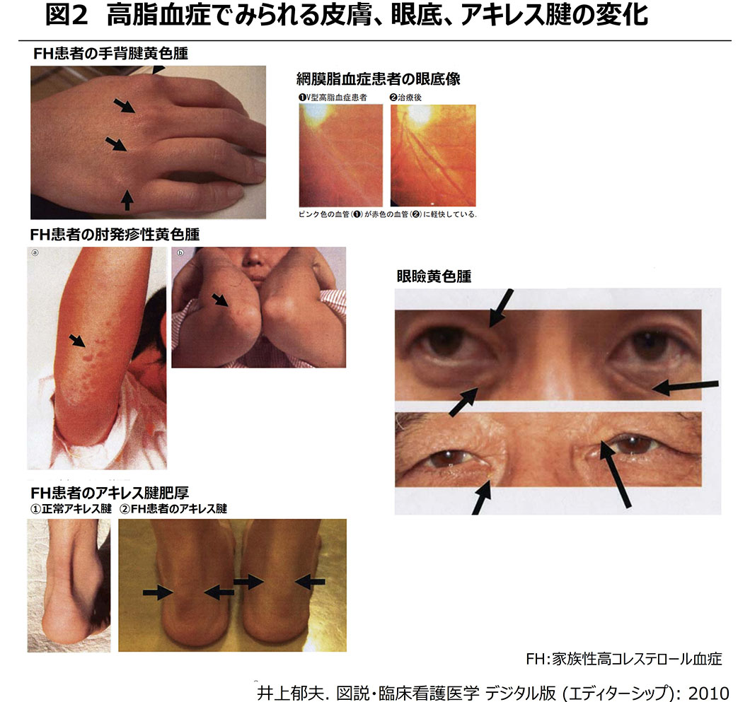 高脂血症解説図2