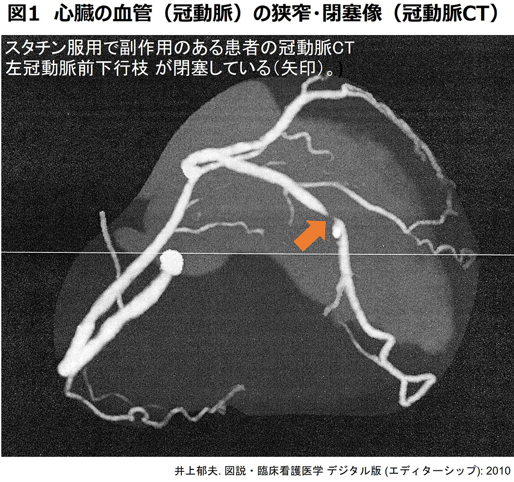 高脂血症解説図1