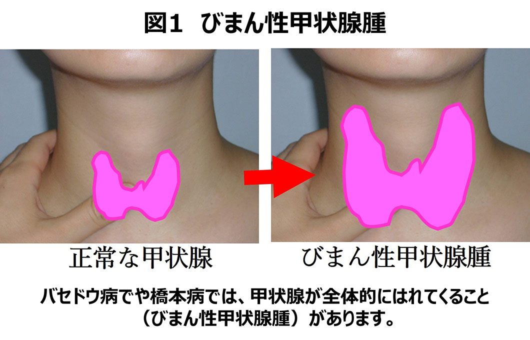 橋本病解説図