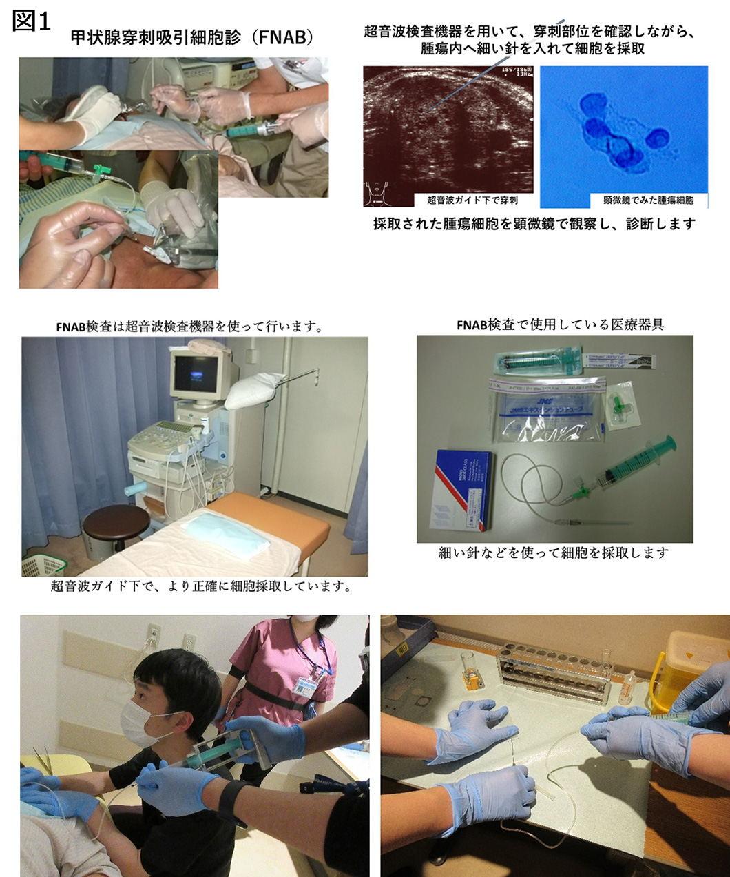 甲状腺腫瘍解説図1