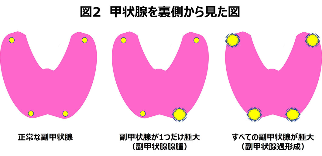 副甲状腺機能亢進症解説図2