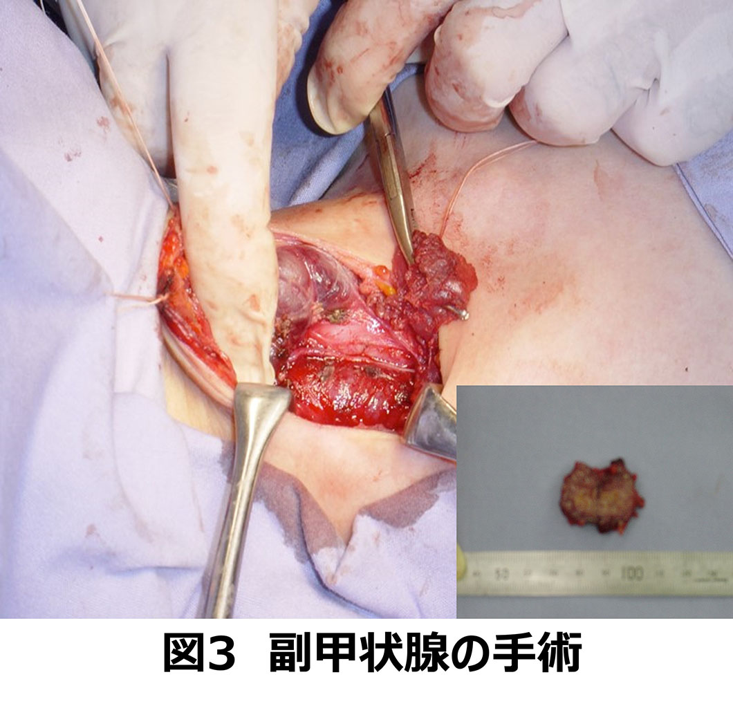 副甲状腺機能亢進症治療方法図3