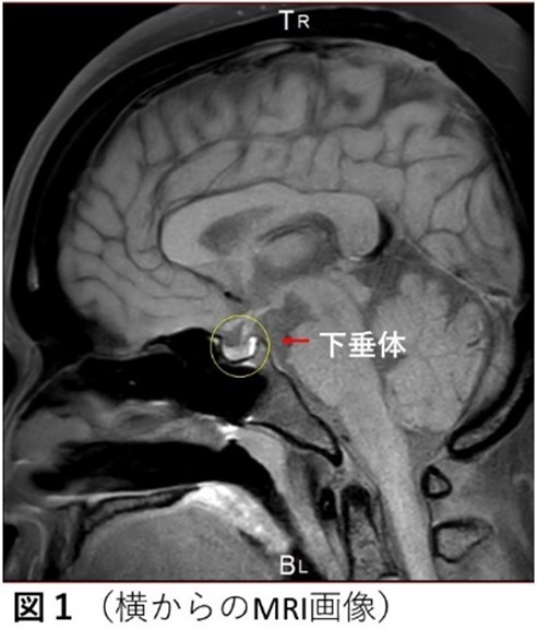 下垂体腫瘍解説図1