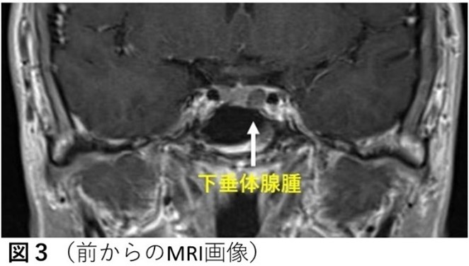 下垂体腫瘍解説図3