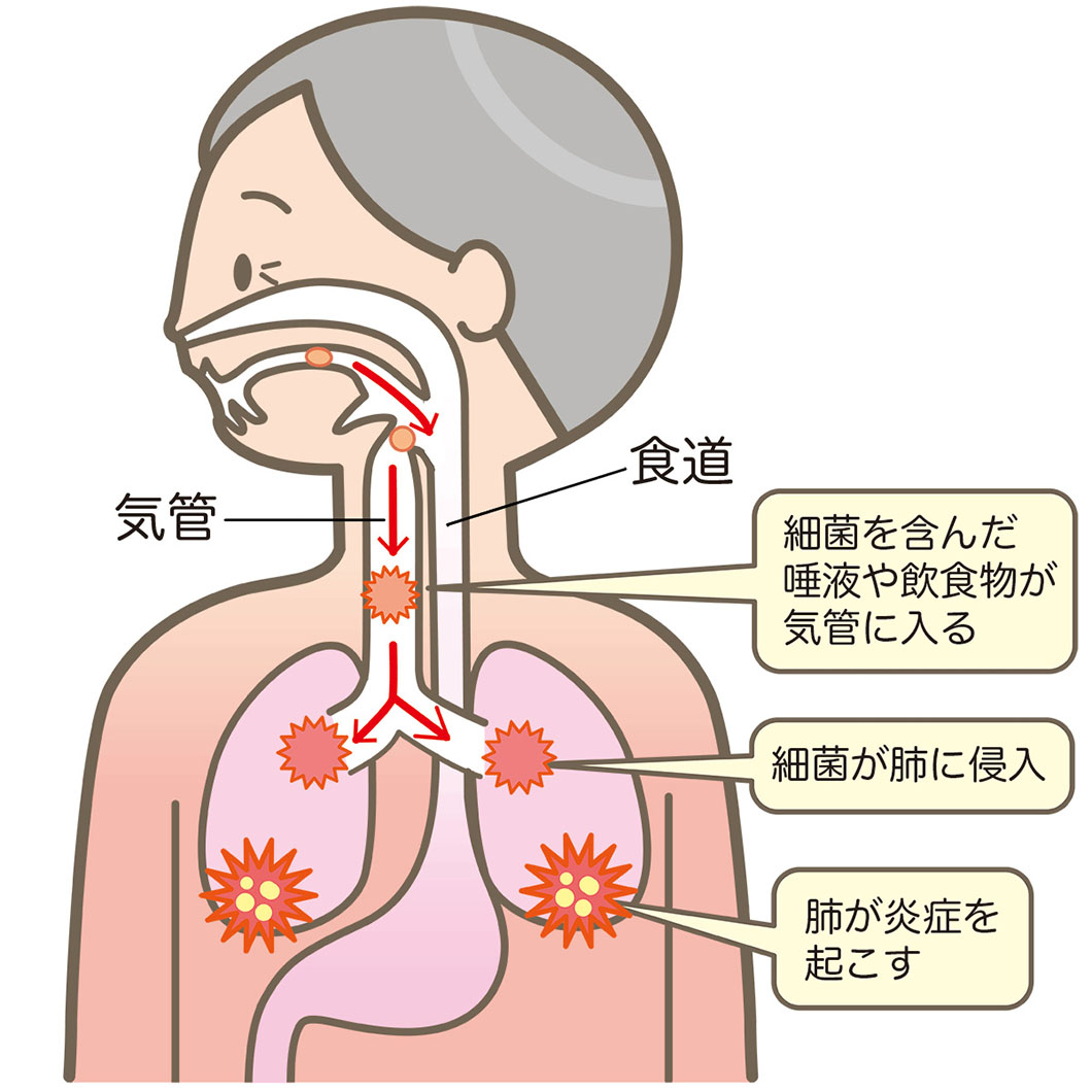 誤嚥性肺炎01